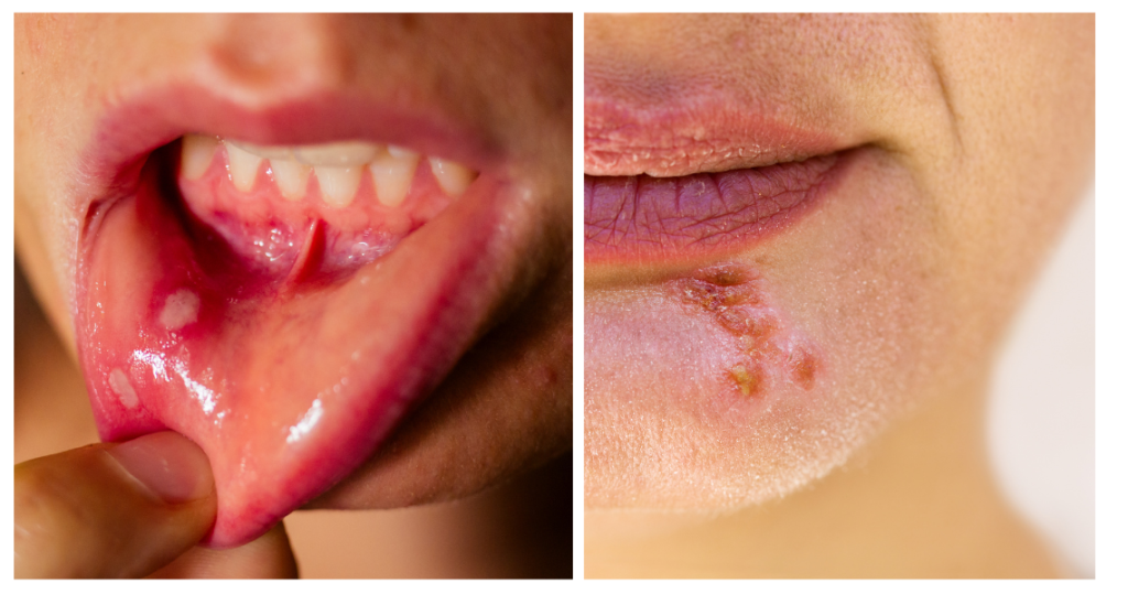 herpes ili afta